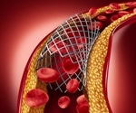 Erectile dysfunction drug may be used to coat stents in future heart surgeries