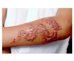 Dermatologists find increasing incidence of reaction to black henna tattoos
