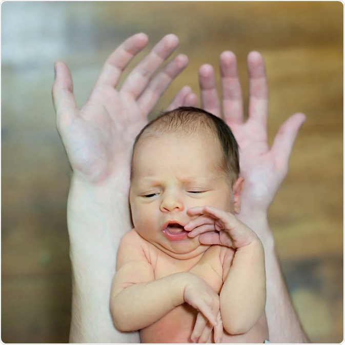 4 days old newborn baby laying on parents hands. Baby has neonatal jaundice. Image Credit: Alina R / Shutterstock