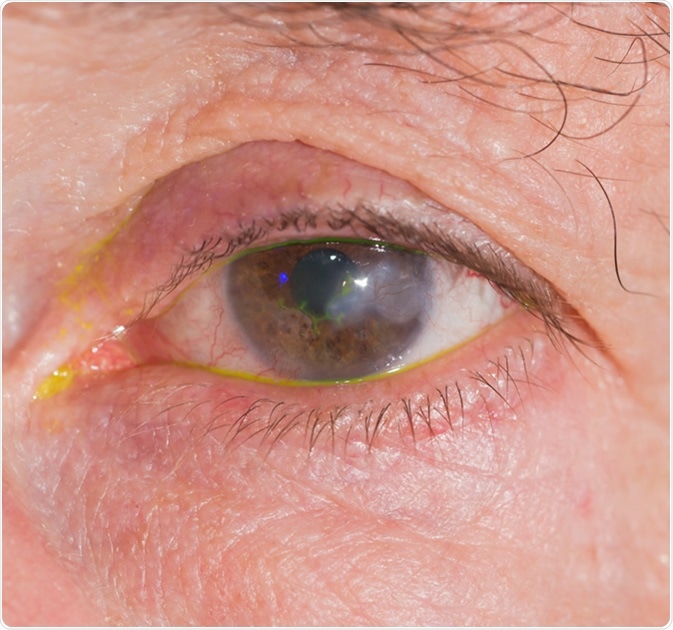 Close up of eye examination, Herpes keratitis. Image Credit: ARZTSAMUI / Shutterstock