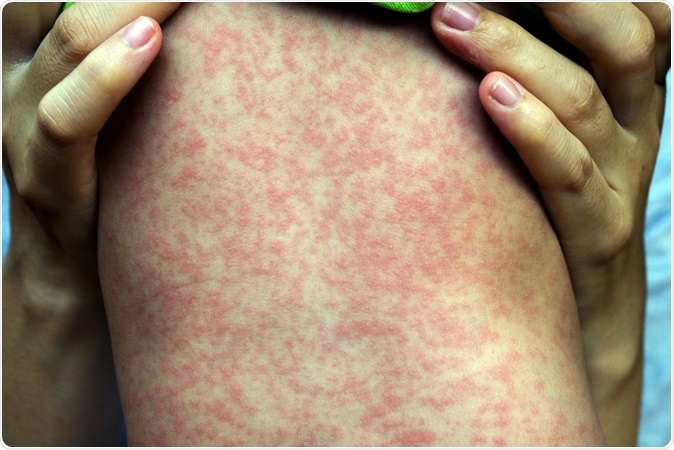 Measles rash - Image Credit: Phichet Chaiyabin / Shutterstock