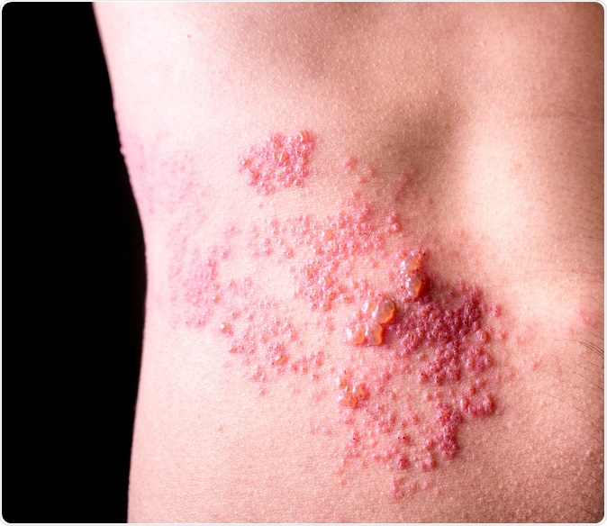Raised red bumps and blisters caused by shingles on skin. Image Credit: adtapon duangnim / Shutterstock