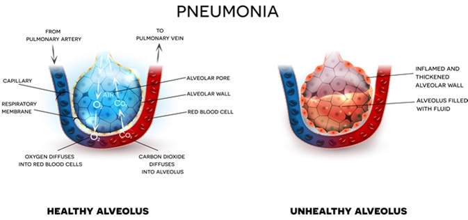Pneumonia illustration, alveoli with fluid and healthy Alveoli, oxygen and carbon dioxide exchange between alveoli and capillaries. Image Credit: Tefi / Shutterstock