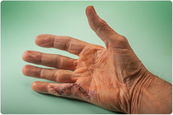 Results of hand surgery for Dupuytren