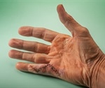 Dupuytren’s Contracture: Causes and Symptoms