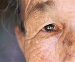 Global blindness rates expected to soar within a few decades
