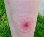 New biomarkers for early Lyme Disease identified