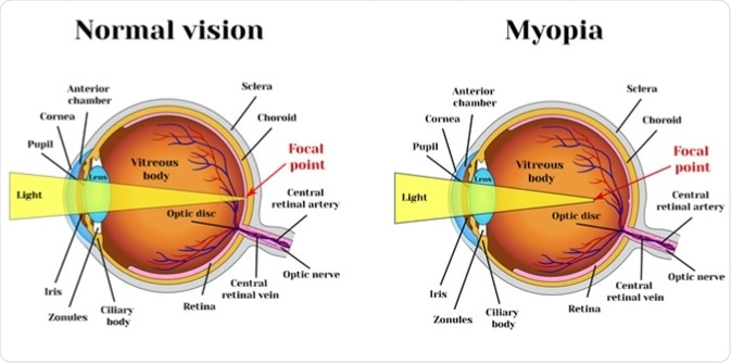 what makes a person near sighted