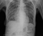 Tuberculosis Diagnosis