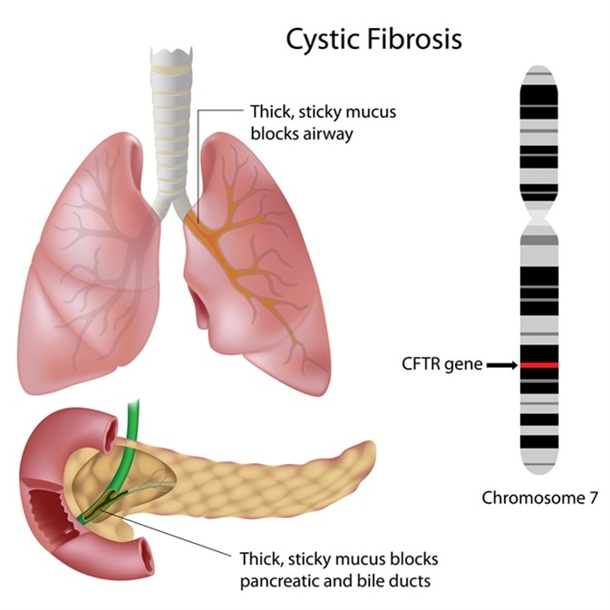 Cystic fibrosis. Image Credit: Alila Medical Media / Shutterstock