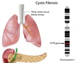 Tests for Cystic Fibrosis During Pregnancy