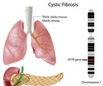 Cystic Fibrosis Epidemiology