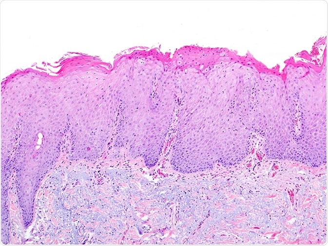 Skin biopsy showing solar elastosis and actinic keratosis due to exposure to UV rays, excessive sun exposure. The dermal region contains elastic blue fibers and the epidermis is irregularly thickened. Image Credit: vetpathologist / Shutterstock