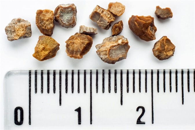 Kidney stones after ESWL intervention. Lithotripsy. Scale in centimeters. Image Credit: Evan Lorne / Shutterstock
