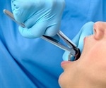Reasons for a Dental Extraction