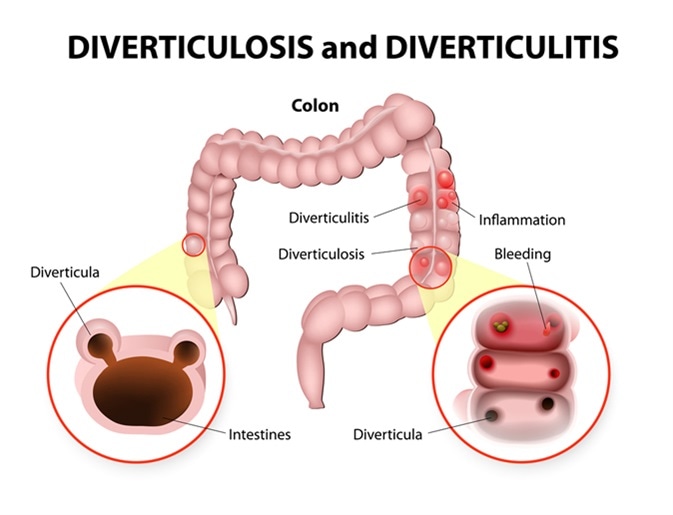 Diverticulosis and Diverticulitis. Image Credit: Designua / Shutterstock