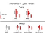 Cystic Fibrosis and Infertility