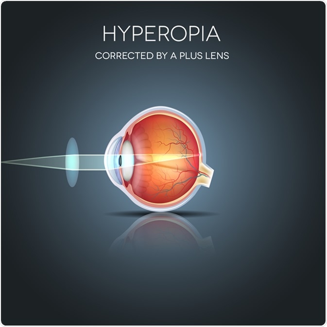 Hyperopia corrected by a plus lens. Hyperopia is being long sighted (far sighted). Near object seems blurry. Image Credit: Tefi / Shutterstock
