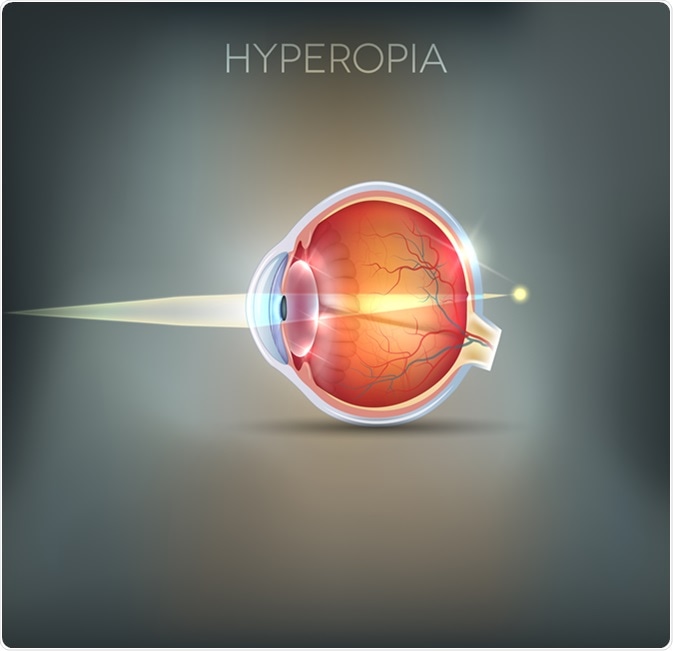 Hyperopia, vision disorder being long sighted. Near object seems blurry. Image Credit: Tefi / Shutterstock