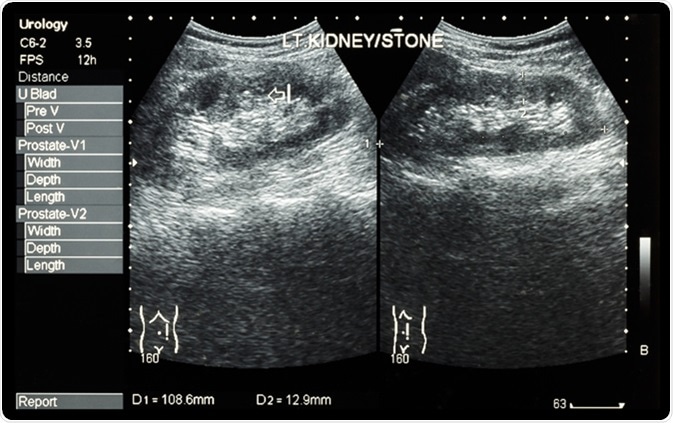 Ultrasonography of kidney : show left kidney stone. Image Credit: Puwadol Jaturawutthichai / Shutterstock