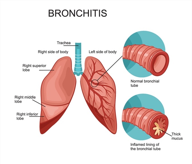 Bronchitis. Image Credit: logika600 / Shutterstock