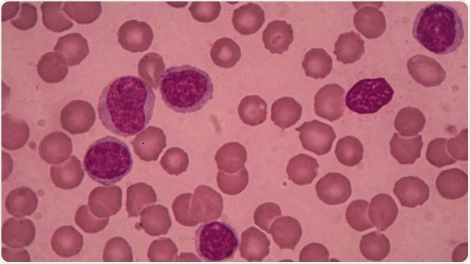 Blood smear showing chronic lymphoblastic leukemia (CLL). Image Credit: Medtech THAI STUDIO LAB 249 / Shutterstock
