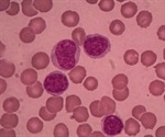 Chronic Lymphocytic Leukemia Causes