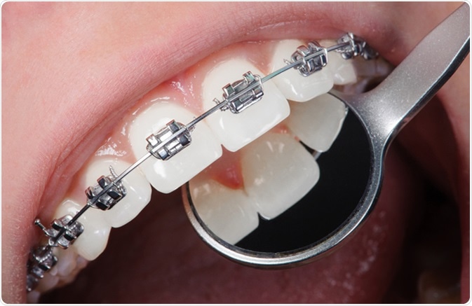 Open mouth showing stainless steel braces. Image Credit: Anatoliy_gleb / Shutterstock
