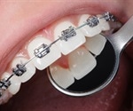 Risks of Dental Braces