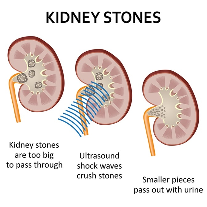 Shock waves used to break a kidney stone into small pieces that can more easily travel through the urinary tract and pass from the body. Imaged Credit: Neokryuger / Shutterstock