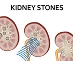 Kidney Stones - Treatment