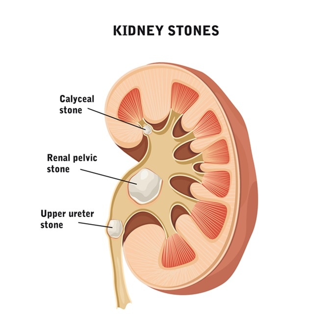 Kidney stones illustration. Image Credit: logika600 / Shutterstock