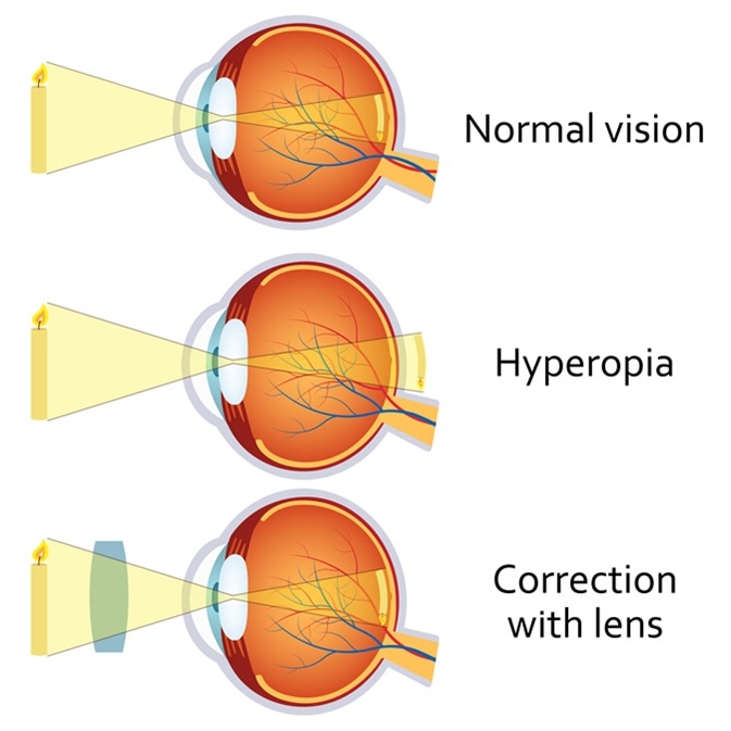 Hyperopia and Hyperopia corrected by a plus lens. Eye vision disorder. Image Credit: Neokryuger / Shutterstock