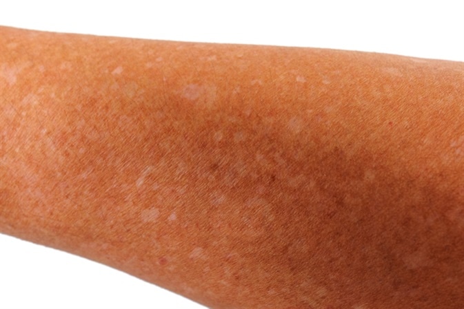 Small white spots on arms (Idiopathic guttate hypomelanosis). Image Credit: Tee11 / Shutterstock