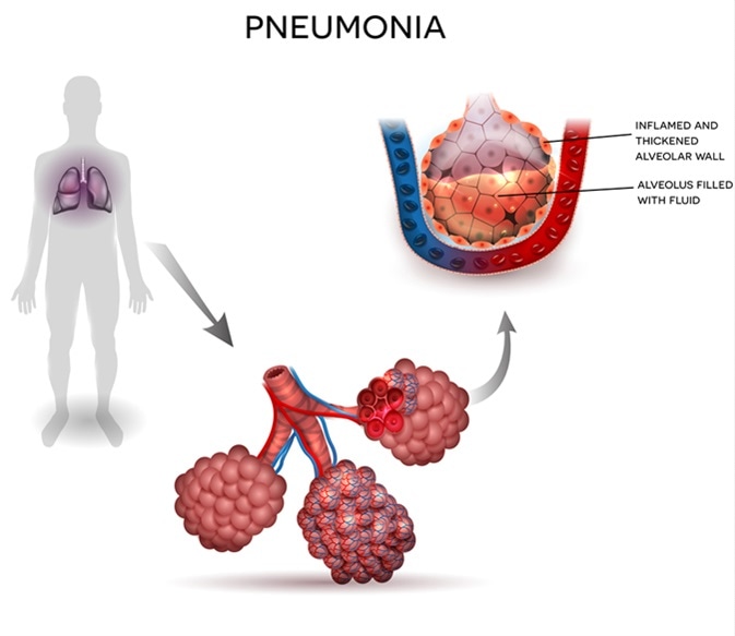 Pneumonia illustration, human silhouette with lungs, close up of alveoli and inflamed alveoli with fluid inside. Image Credit: Tefi / Shutterstock