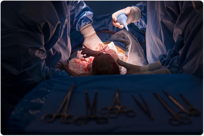 Cesarean section operation in process. Image Credit: Elis Blanca / Shutterstock