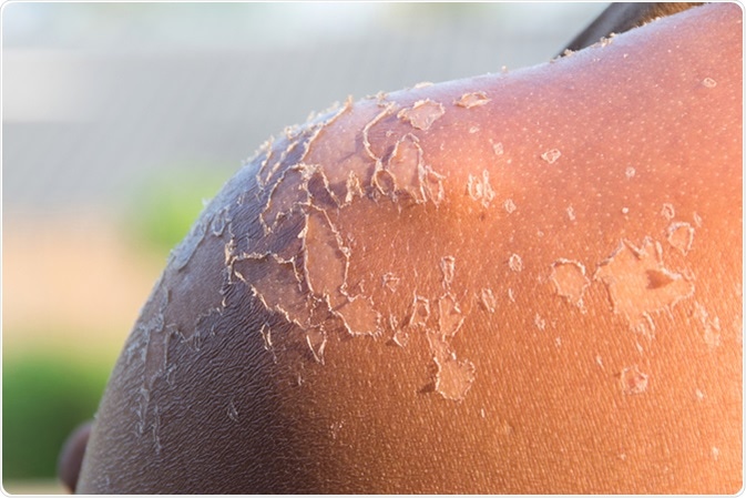 Hombro de la peladura del suburn. Haber de imagen: Myibean/Shutterstock