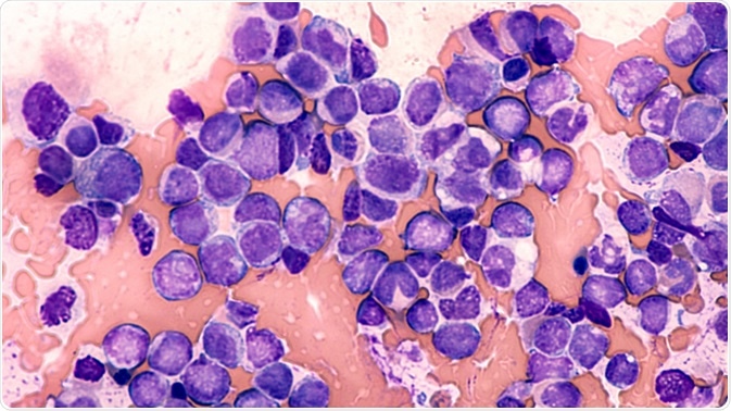 Photomicrograph of bone marrow aspirate from a patient with leukocytosis, showing blast cells of acute myeloid leukemia (AML), type M5, myelomonocytic, cancer of white blood cells. Image Credit: David Litman / Shutterstock