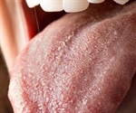 Oral Candidiasis Causes