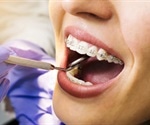 Procedure for Dental Braces