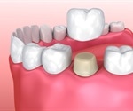 Dental Crown Uses