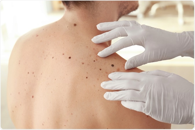 Dermatologist examining melanomas. Africa Studio / Shutterstock