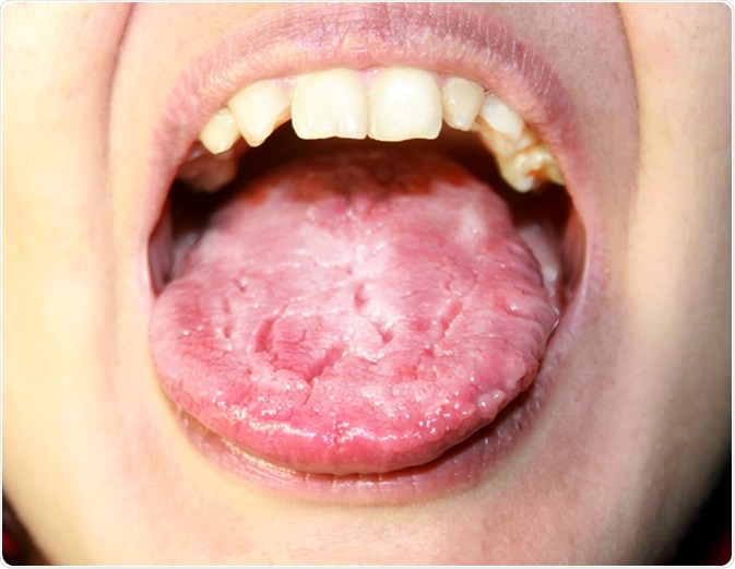 Candidiasis on the tongue. Image Credit: Timonina / Shutterstock
