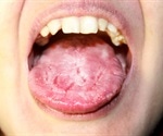 Oral Candidiasis (Oral Thrush)
