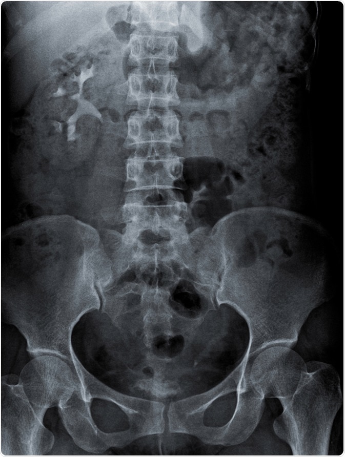Radiography of kidney with intravenous Contrast at one hour. Image Credit: kaling2100 / Shutterstock