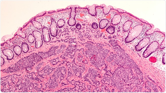 Photomicrograph of a carcinoid tumor, a type of neuroendocrine tumor (NET), which presented as a colon polyp during routine colonoscopy. Spread to liver can cause symptoms of carcinoid syndrome. Image Credit: David Litman / Shutterstock