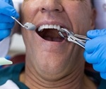 Procedure for Dental Extraction