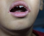 Actinic Cheilitis - Symptoms and Causes
