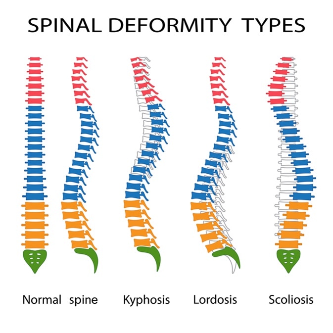 Illustration of spinal deformity types. Kyphosis, lordosis and scoliosis. Image Credit: Neokryuger / Shutterstock