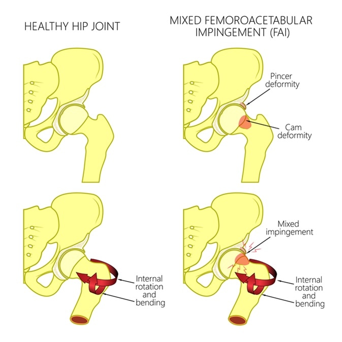 Illustration of a healthy human hip joint and a hip with mixed femoroacetabular impingement. Front view of hip joint with section of the pelvis. For advertising and medical publications. Image Credit: Aksanaku / Shutterstock